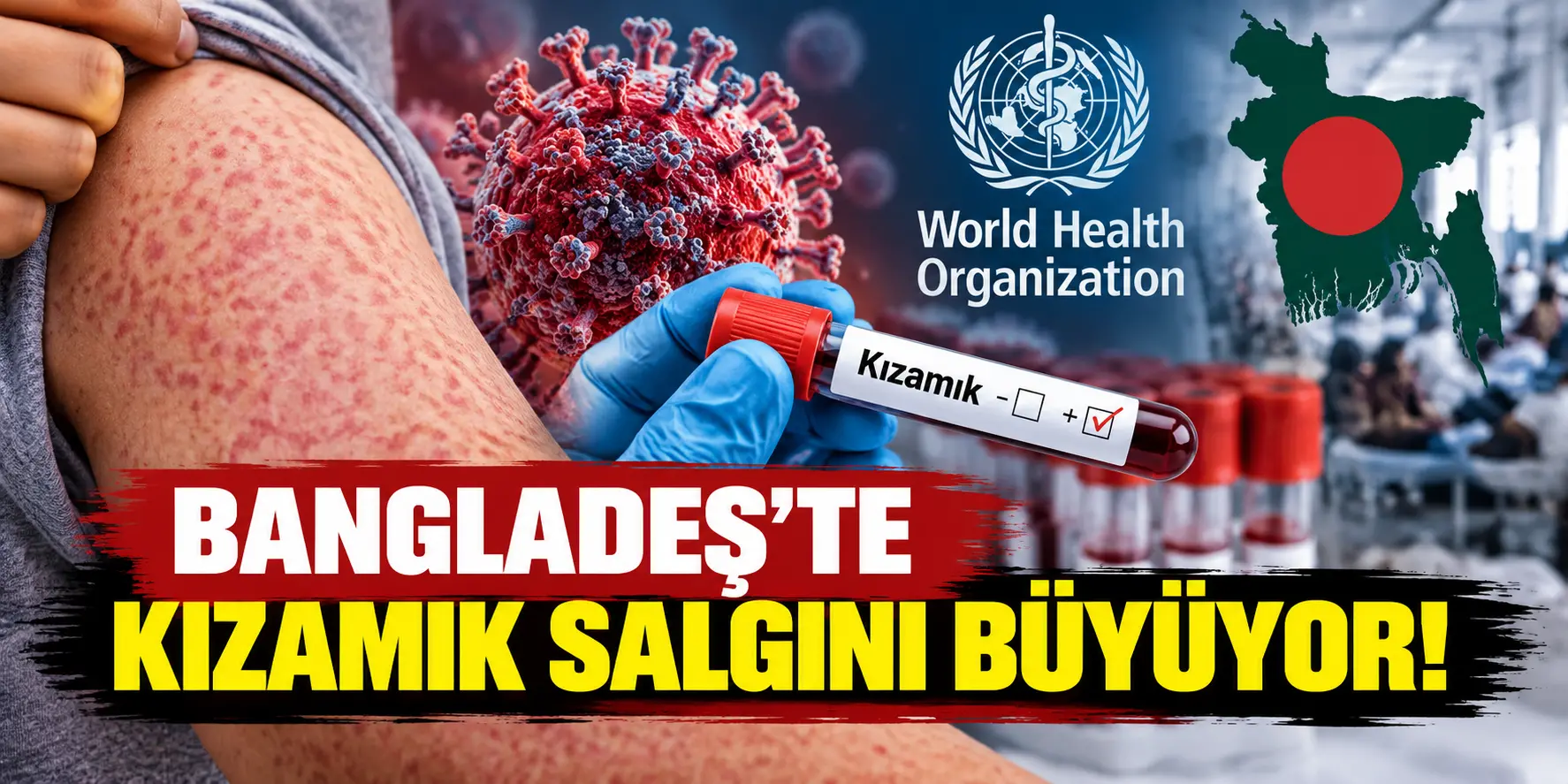 angladeş’te Kızamık Salgını Büyüyor: Hayatını Kaybeden Çocuk Sayısı 1.201’e Yükseldi!