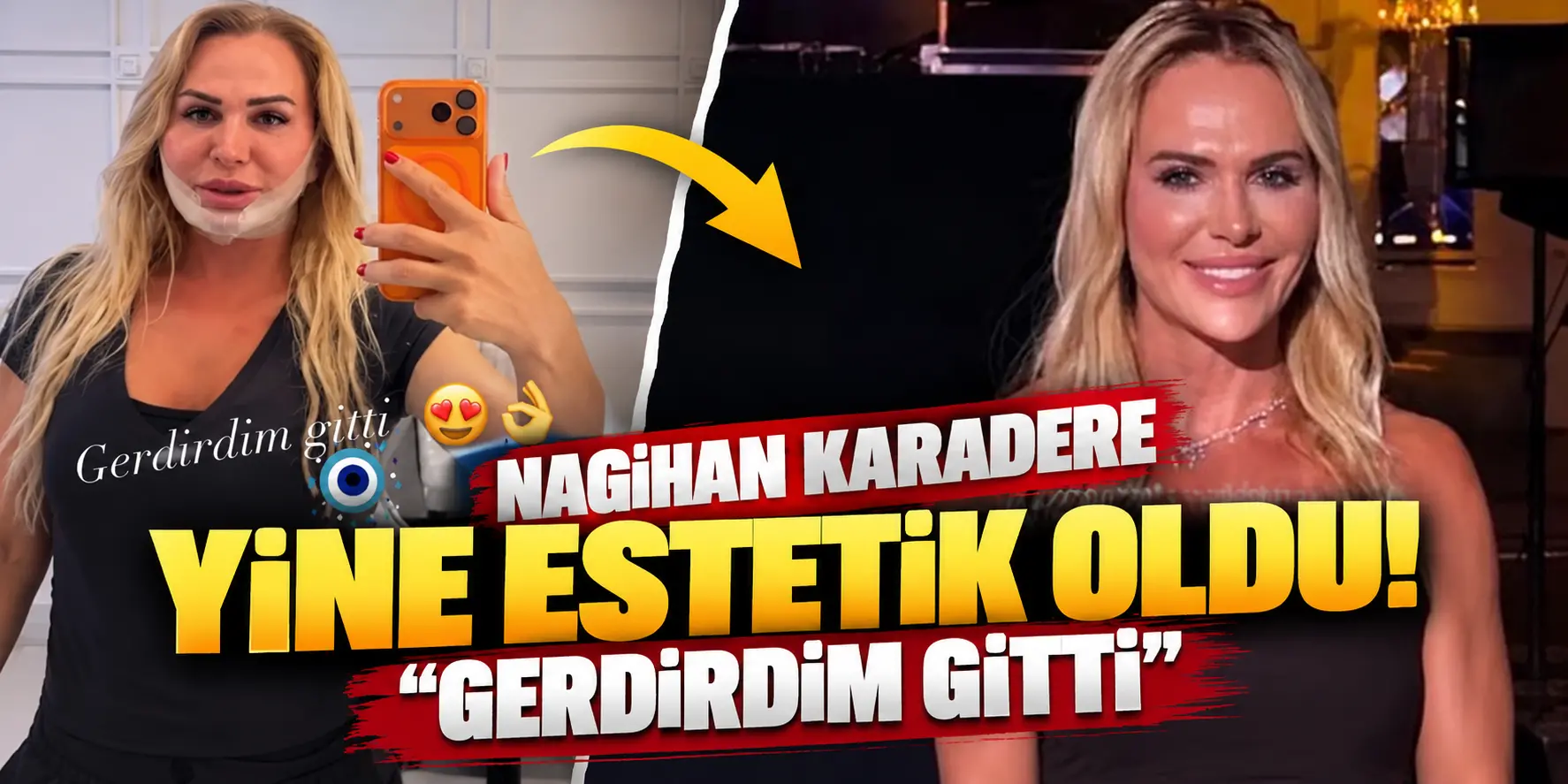 Nagihan Karadere yine estetik yaptırdı! “Gerdirdim gitti” diyerek son halini paylaştı