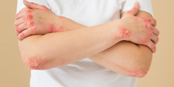 Romanya ve Hırvatistan’da yıllar sonra cüzzam vakaları tespit edildi