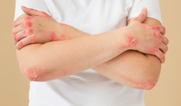 Romanya ve Hırvatistan’da yıllar sonra cüzzam vakaları tespit edildi